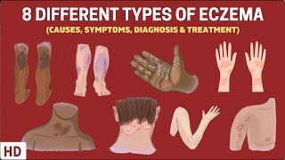 Eczema Exposed 8 Types You Need to Know [upl. by Roma]