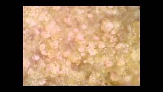 Scabies mites on skin crust [upl. by Wald]