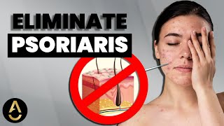 What To Do If You Have Acne and Psoriasis [upl. by Nerra]