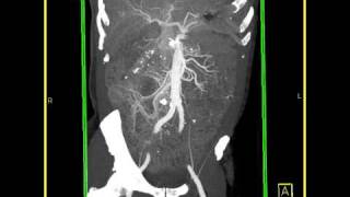 Abdomen Small Bowel Carcinoid tumor of the small bowel MIP images [upl. by Nosinned]