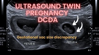 Ultrasound twin pregnancy gestational sac discrepancy Dichorionic diamniotic twin pregnancy [upl. by Valerian]