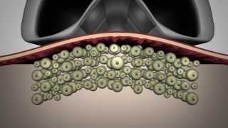 LipoContrast  One step beyond cryolysis [upl. by Paynter]