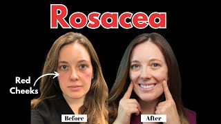 Best Ways to Treat Rosacea [upl. by Tad]