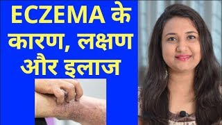 Eczema Home Made Remedy  घरेलू नुस्खे से दूर होगी खुजली और सूजन बचेंगे पैसेकभी नही होगा इंफेक्शन [upl. by Afatsom]