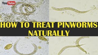 How To Treat Pinworms  Pinworm Treatment Home Remedy  Pictures Of Pinworms [upl. by Aicekal]