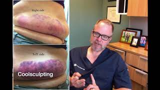 Sculpsure vs Coolsculpting  Which One is Better [upl. by Leoy101]