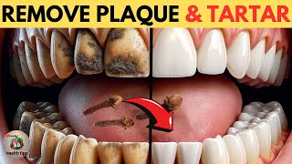 Remove Plaque amp Tartar Buildup with these 6 Natural Ways [upl. by Stasny]