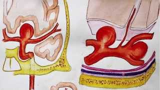 Understanding Brain aneurysm and endovascular coiling [upl. by Wernda258]