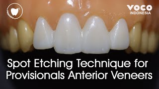 Spot Etching Technique for Provisionals Anterior Veneers Temporary Veneers ǀ Structur 3  VOCO GmbH [upl. by Noevad991]