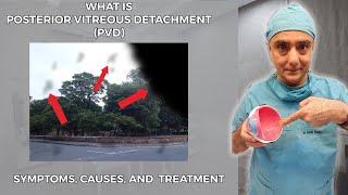 What is Posterior Vitreous Detachment PVD Symptoms Causes and Treatment [upl. by Oetsira]