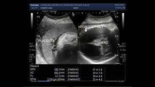 Ultrasound Video showing Fetal hydrocephalus due to ventriculomegaly [upl. by Enelram]