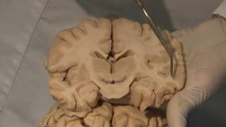 Cortical Localization Neuroanatomy Video Lab  Brain Dissections [upl. by Ybbil]