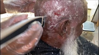 How to get rid 100year old dandruff 🥵dandruff flakes 😱 dandruff combing [upl. by Ssej]