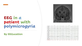 EEG in a Patient with Polymicrogyria [upl. by Ireva171]