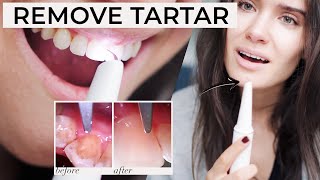 HOW TO REMOVE PLAQUE TARTAR AT HOME  Ultrasonic Tooth Cleaner Review  Does It Work [upl. by Tterrag21]