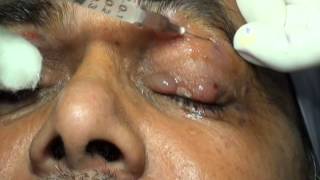 Botulinum Toxin Injection for Blepharospasm and Hemifacial Spasm Drs Vidushi Suresh Pandey SuVi Eye [upl. by Aloel436]