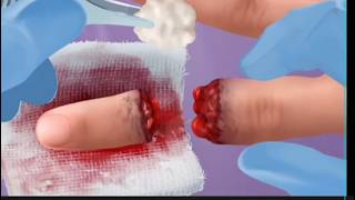 ASMR Surgery broken finger and Removal tonsil stone Treatment [upl. by Bertsche739]