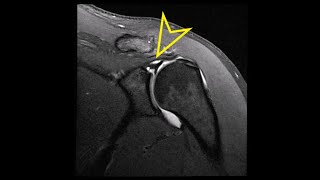 Shoulder MRI Labral SLAP Superior Labrum Anterior Posterior Tear [upl. by Elodea788]