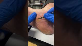 Learn how a Podiatrist expertly removes Medial Foot Callus Removal  Corn and Callus Treatment [upl. by Nujra]