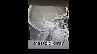 mastoid x ray ear x ray radiology shortvideo [upl. by Hewe]