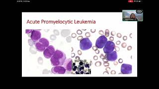 MOLECULAR DIAGNOSIS OF CANCER HEMATOPATHOLOGY [upl. by Ahouh]