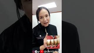 Limpieza dental o Curetaje periodontal❓😉 quito ecuador shorts tips youtubeshorts [upl. by Anuahsal]