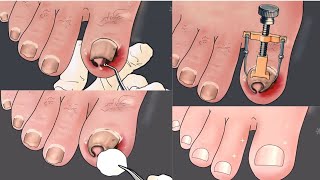 ASMR  Remove ingrown toenail  toenail treatment satisfying  oddly treat toeanil [upl. by Nyrac]