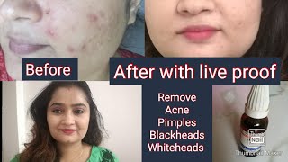 Berberis Aquifolium को कैसे Use करें की आपको सबसे अच्छे Result मिले  for face problem [upl. by Adnauqaj]