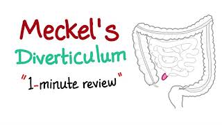 Meckels Diverticulum 1minute review [upl. by Tillman943]