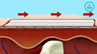 How Mepilex Border Dressing helps in Pressure Ulcer Prevention [upl. by Johnstone]