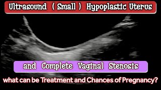 Ultrasound Small Hypoplastic Uterus and Vaginal Stenosis [upl. by Ellenad561]