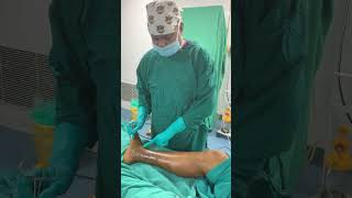 How LASER is used to treat varicose vein [upl. by Hyams542]