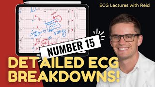 EKG Test Yourself  ECG Case Study 15 [upl. by Petrina615]