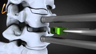 Hernie discale cervicale  Spinal disk herniation  Kisco International [upl. by Almena588]