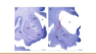 Huntington Disease Neuropathology Lecture [upl. by Albertina]