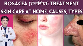 Rosacea Treatment Skin Care Laser Treatment  Rosacea का इलाज  Rosacea Causes Types  Hindi [upl. by Micheil351]