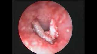 Fruitfly Larva in the Auditory Canal  NEJM [upl. by Atirahs]