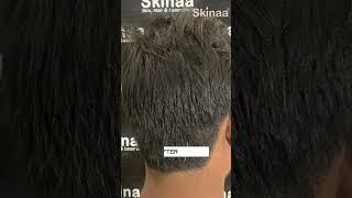 Alopecia Areata Treatment with ILS at Skinaa Clinic viral shorts [upl. by Forrester849]