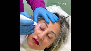 Nonsurgical Blepharoplasty fibroblasting blepharoplastic plasmalifting plasmapen [upl. by Ativad389]