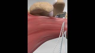 Subscapularis tendon repair  animationshorts shortsfeed youtubeshorts viralshorts [upl. by Nolahs]