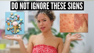 7 Signs You Have Fungal Acne With Pictures [upl. by Odelia]