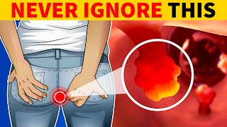 8 Critical Colon Cancer Symptoms You Should Never Ignore 15 Million Views [upl. by Aneele]