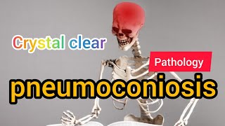 Pneumoconiosis  Pathology  MAT Medicos [upl. by Darcey]