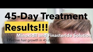 Minoxidil and Finasteride 5 Topical Solution results after 45 days and shedding phase [upl. by Ibrik]