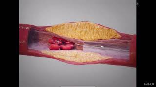 Atherosclerosis Procedure Medicalschooleasylearning [upl. by Kiernan]