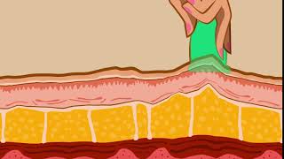 How Cellulite Massage Cups Work On The Dermis [upl. by Shepley302]