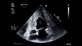 Endomyocardial Fibroelastosis [upl. by Yoshiko744]