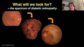 Lecture Screening amp Referral for Diabetic Retinopathy [upl. by Niatsirt]