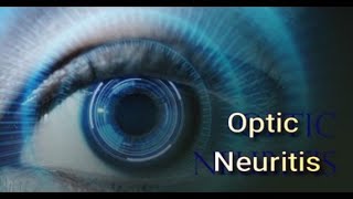 Optic Neuritis Alternative Treatment  Mind Over MS Podcast Episode 18 [upl. by Stegman]