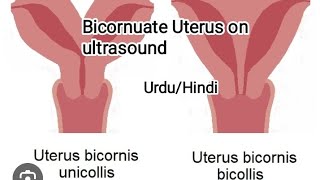 Pelvic UltrasoundBicornuate uterusseptate unterus [upl. by Nur33]